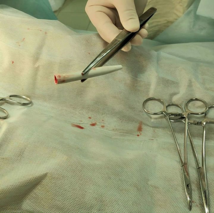 Челнинские врачи достали шариковую ручку из полового органа молодого мужчины