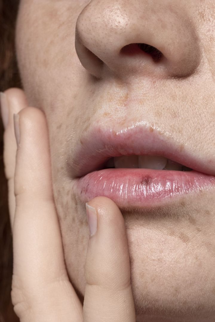 Потрескавшиеся губы могут быть симптомом внутреннего воспаления