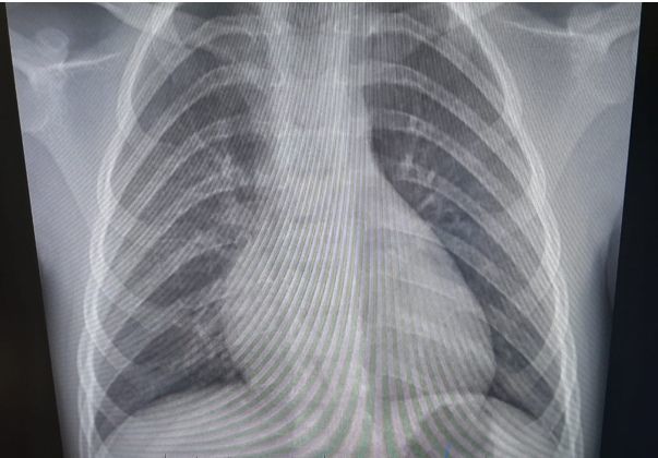 Туберкулезом может заболеть и ребенок